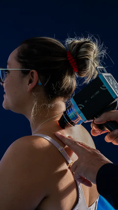 Dermatoscopia digital de un nevo en el hombro de una paciente