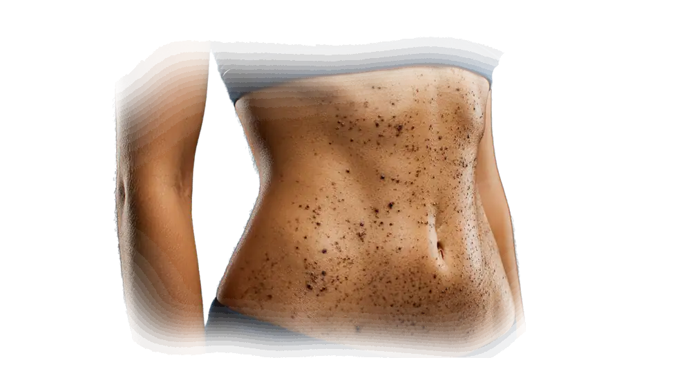 Piel de abdomen y espalda con numerosos nevos pigmentados